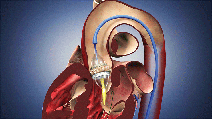 TAVR Minimally Invasive Approach for Aortic Stenosis