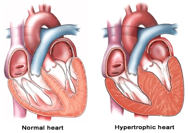 What is cardiomyopathy?