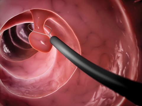 What is a colonoscopy?