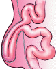 A hernia with intestine bulging through a hole in the abdominal muscles.