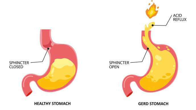 Healthy vs Gerd Stomach