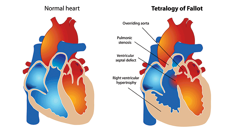 congenital heart disease