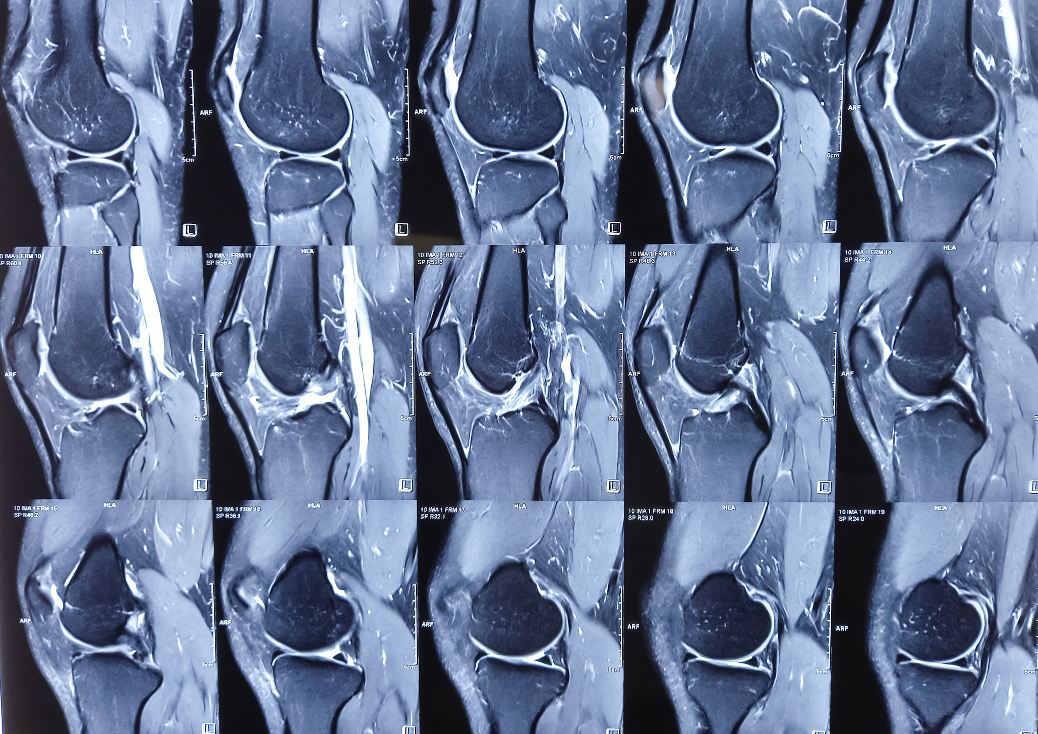 MRI of knee, bone scan