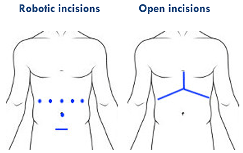 Side by side illustrations of two human torsos showing the different surgical incision lines for robotic versus open surgeries