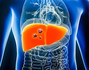 3D illustration of a human torso in blue showing the internal organs with the liver highlighted in red with tumors