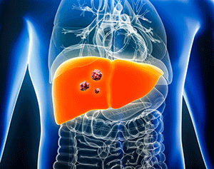 3D illustration of a human torso in blue showing the internal organs with the liver highlighted in red with tumors