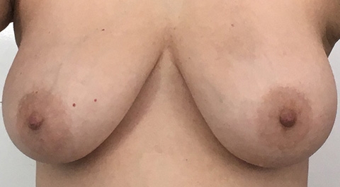 Pre-surgery (slight bruising from the needle biopsy), March 6, 2018
