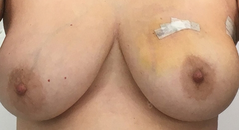 Post-surgery, March 20, 2018