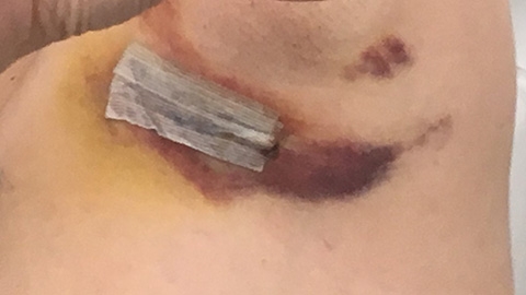 Bad bruising under arm because I overdid it, bad me. March 23, 2018