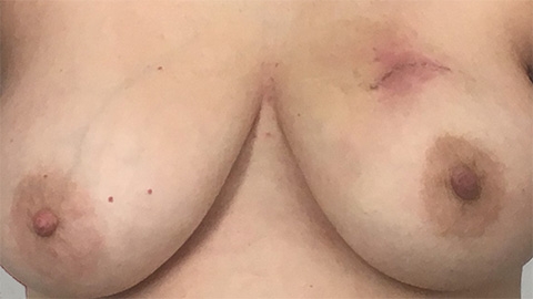Scar tissue giving my breast some lift! April, 6 2018
