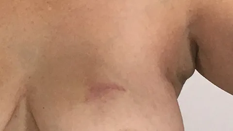 Some underarm puffiness. July 14, 2018