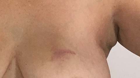 Some underarm puffiness. July 14, 2018