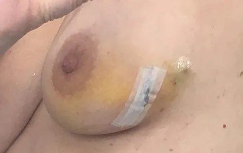 Several days after the second surgery. October 29, 2018