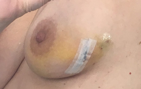 Several days after the second surgery. October 29, 2018