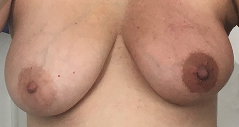 About a week after full breast radiation ended, I suddenly looked tan. January 2, 2019