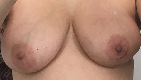 After the second surgery and radiation, my right breast is a little strangely shaped. Tan color mostly sloughed off. January 31, 2019