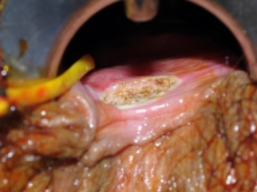 A. The internal opening is cleared. Small flaps are made to expose the muscle of the internal sphincter.