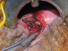 B. The internal sphincter is closed with deep stiches.