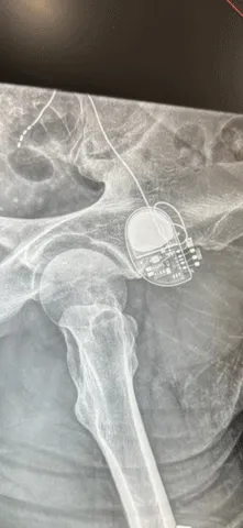 A scan of Frank's BOOM-IBD device after implantation.