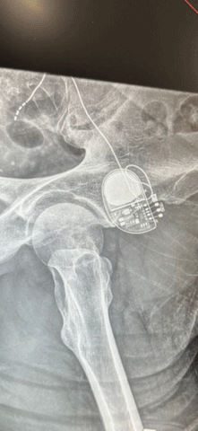 A scan of Frank's BOOM-IBD device after implantation.