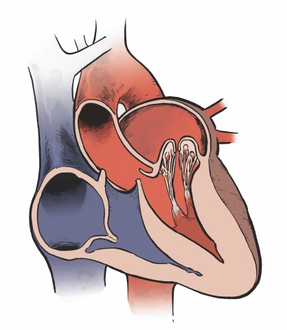 Drawing of a heart showing mitral valve prolapse