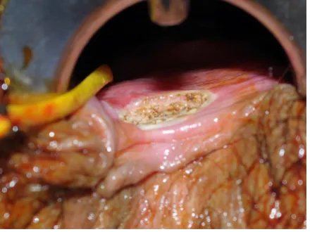 Fistula image A