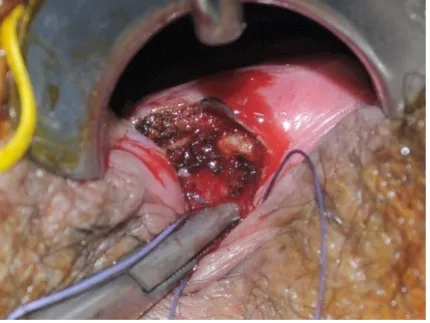 Fistula image B