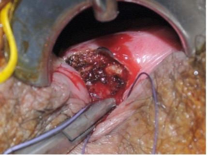 Fistula image B