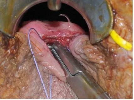 Fistula image C