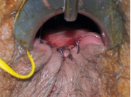 Fistula image D
