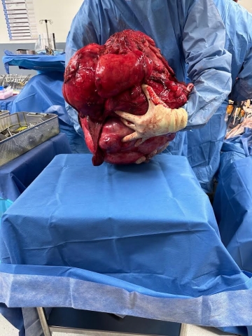 Tumor after removal in the OR