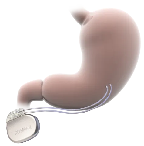image of the enterra device implanted with wires into the stomach