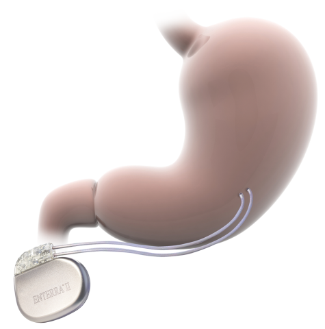 image of the enterra device implanted with wires into the stomach
