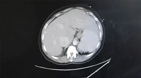 Image showing congestion within the liver that led to cirrhosis.