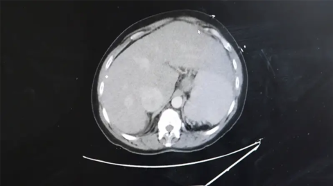 Image showing congestion within the liver that led to cirrhosis.