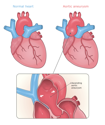 Normal heart and heart with ascending aortic aneurysm vector medical illustration labeled.