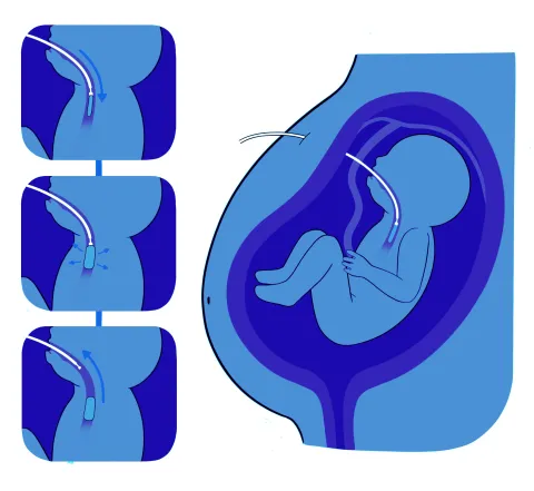 A diagram demonstrating the steps of the FETO procedure