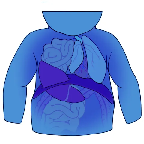 Diagram showing right-sided congenital diaphragmatic hernia in a baby