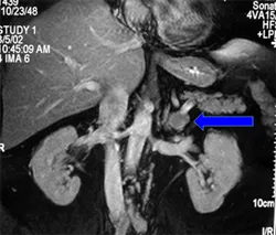 Adrenal adenoma on CT