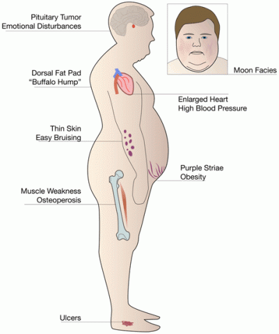 Cushing Syndrome: Causes, Symptoms & Treatment