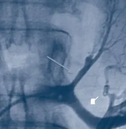 Venograms of the right and left adrenal glands.