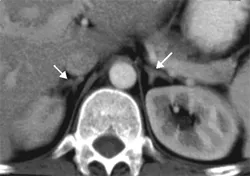 Normal adrenal glands on CAT scan