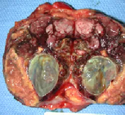 A look inside a pheochromocytoma
