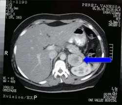 CAT scan of Pheochromocytoma