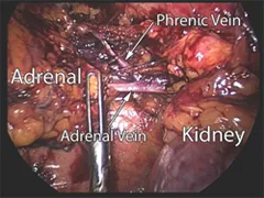 View of the left adrenal gland and surrounding organs through the laparoscopic retroperitoneal approach View of the left adrenal gland and surrounding organs through the laparoscopic retroperitoneal approach