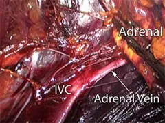 View of the right adrenal gland and surrounding organs through the laparoscopic retroperitoneal approach View of the right adrenal gland and surrounding organs through the laparoscopic retroperitoneal approach