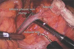 View of the left adrenal gland and left adrenal vein through the laparoscopic transabdominal approach