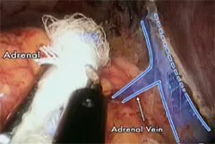 View of the right adrenal gland and right adrenal vein through the laparoscopic transabdominal approach View of the right adrenal gland and right adrenal vein through the laparoscopic transabdominal approach