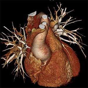 State of the Union: Aortic Care in 2022 | Columbia Surgery