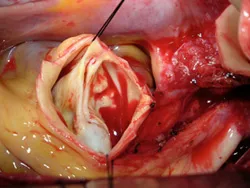 Bicuspid aortic valve